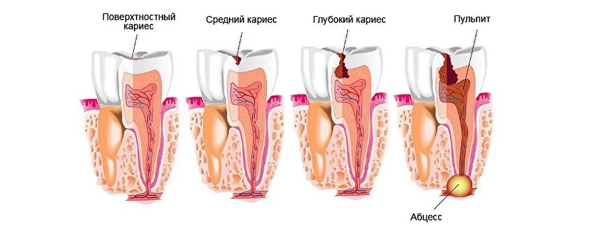 Пульпит у детей молочных зубов