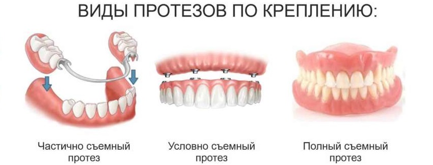 Несъёмное протезирование зубов