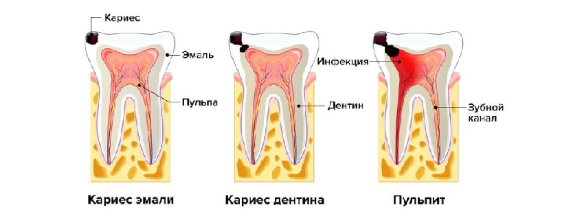 Удаление зубного нерва