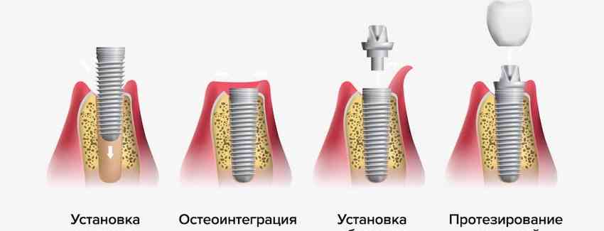 Протезирование зубов на импланты