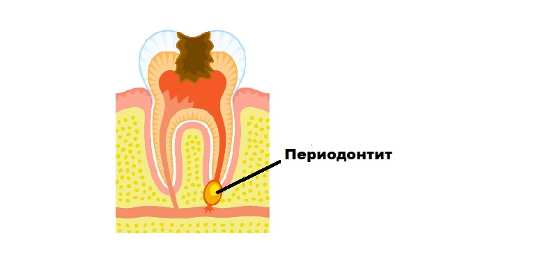 Лечение периодонтита
