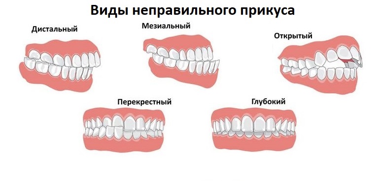 Исправление прикуса