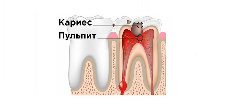 Лечение пульпита