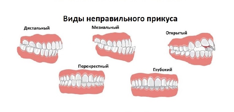 Исправление прикуса без брекетов