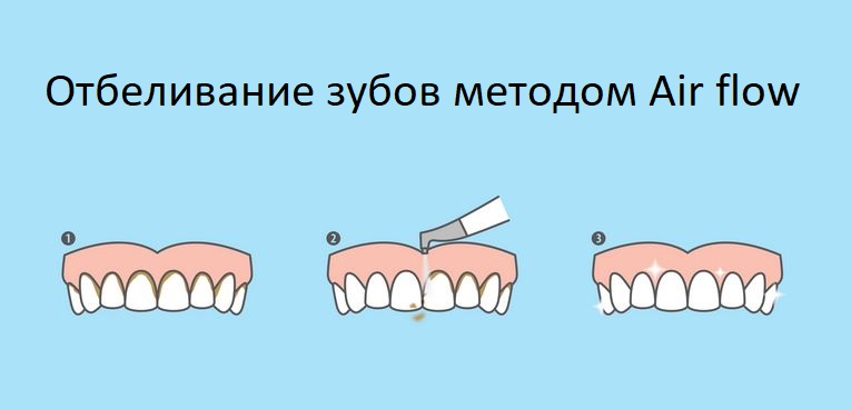  Чищення зубів Air flow